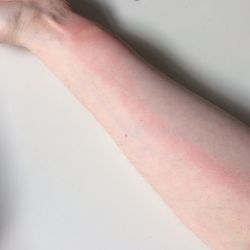 lymphangitis on forearm